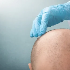 Hidden Fees to Watch for in Hair Transplant Cost UK Estimates